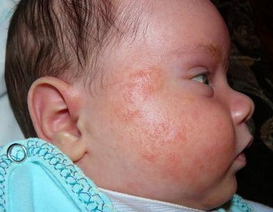 Аллергия у ребенка на домашнее животное